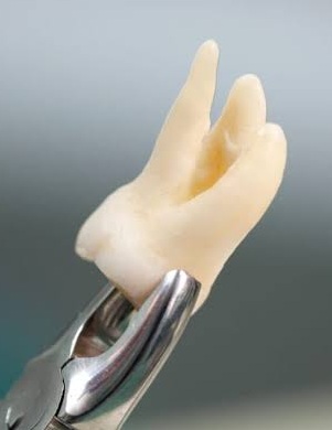 Extracción Dental